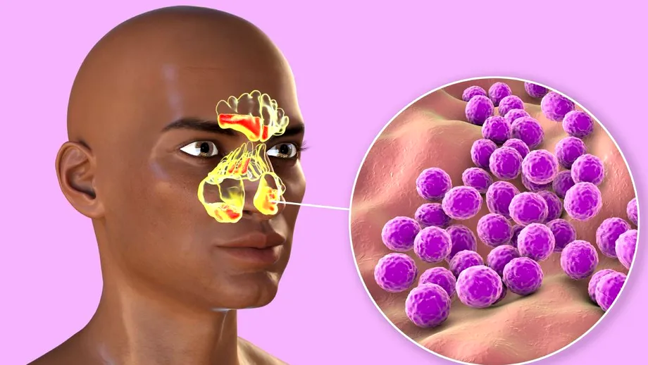 Rinosinuzita, una dintre cele mai frecvente patologii ORL