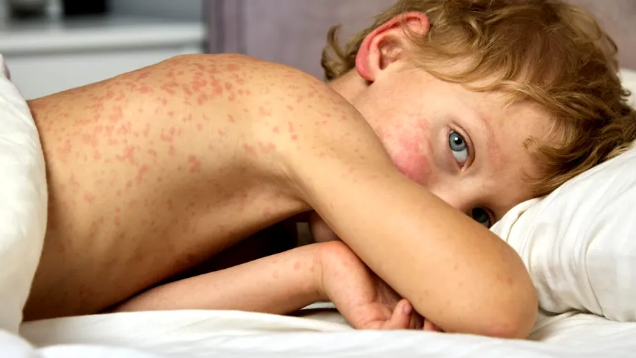 Organizația Mondială a Sănătății, noi alerte din cauza focarelor de rujeolă. România se plasează pe primul loc din Europa la numărul de îmbolnăviri și decese / VIDEO