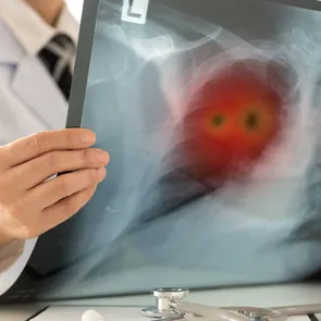 De ce foștii fumători rămân vulnerabili la bolile pulmonare. Ce se întâmplă în plămâni după ce renunți la țigări