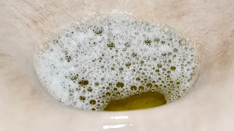 Urina spumoasă, semn timpuriu că rinichii suferă. Ce alte simptome atrag atenția