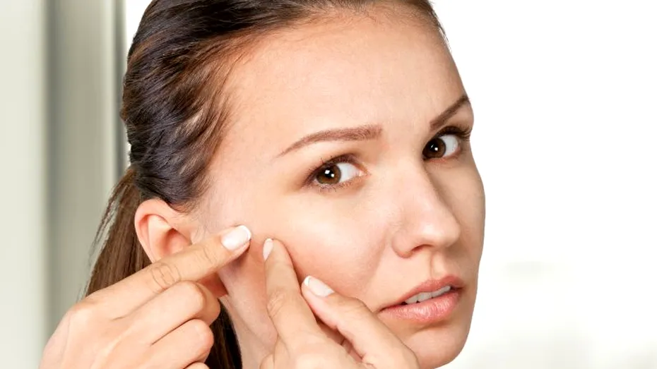Pasta de dinţi şi soarele elimină coşurile? Descoperă 6 mituri frecvente despre acnee