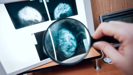 14 mituri și adevăruri despre cancerul mamar