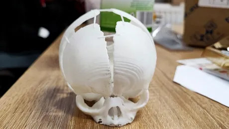 Caz spectaculos. O fetiță născută fără o parte din craniu a fost salvată cu ajutorul unei imprimante 3D