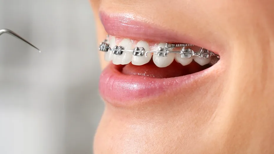 (P) 5 semne clare care indică că ai putea avea nevoie de aparat dentar