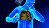 Primele semne de CANCER pulmonar. Unul se vede la analizele de sânge uzuale