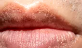 Punctele albe pe buze, penis sau labii nu înseamnă herpes! De ce apar și cum se tratează