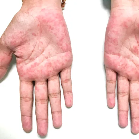 Eczema dishidrotică: ce este, simptome și tratament