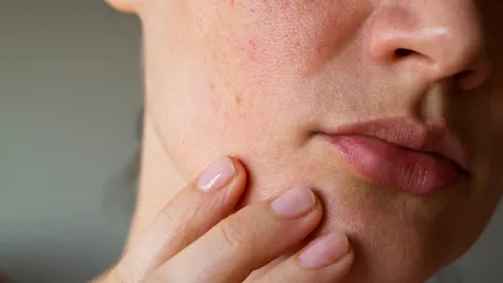 Ai pielea uscată? Aceste alimente și băuturi pot fi de vină