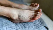 Picioarele crăpate îți pot pune viața în pericol! Află ce semn ascund acestea despre sănătatea ta