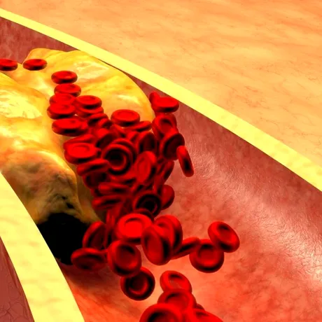 Boli grave cauzate de colesterolul crescut. 4 reguli simple pentru a aduce la normal valorile colesterolului