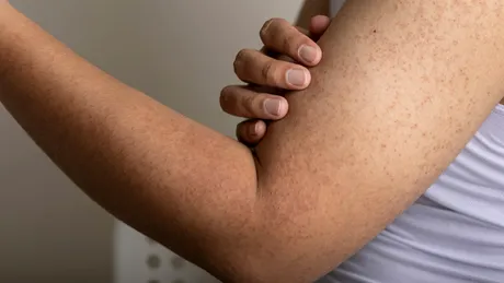 Motivul pentru care apar bubițe roșii pe mâini. 40% din adulți suferă de această boală
