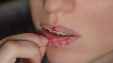 Dermatillomania – când pielea devine ținta unei lupte interioare