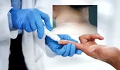 Medicii avertizează: o pată închisă la culoare pe piele poate fi un semn al diabetului de tip 2