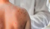 Descoperire majoră în lupta împotriva rujeolei. Cercetătorii au găsit anticorpi capabili să prevină și să trateze infecția