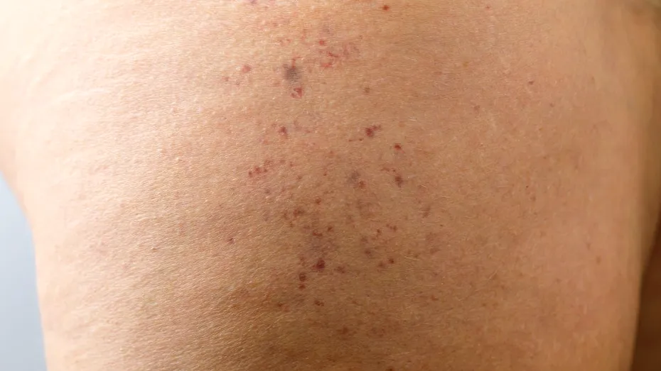 Ce înseamnă dacă îți apar pete mici roșii pe piele? Atenție, poate fi semnul unei boli infecțioase care trebuie tratată urgent!