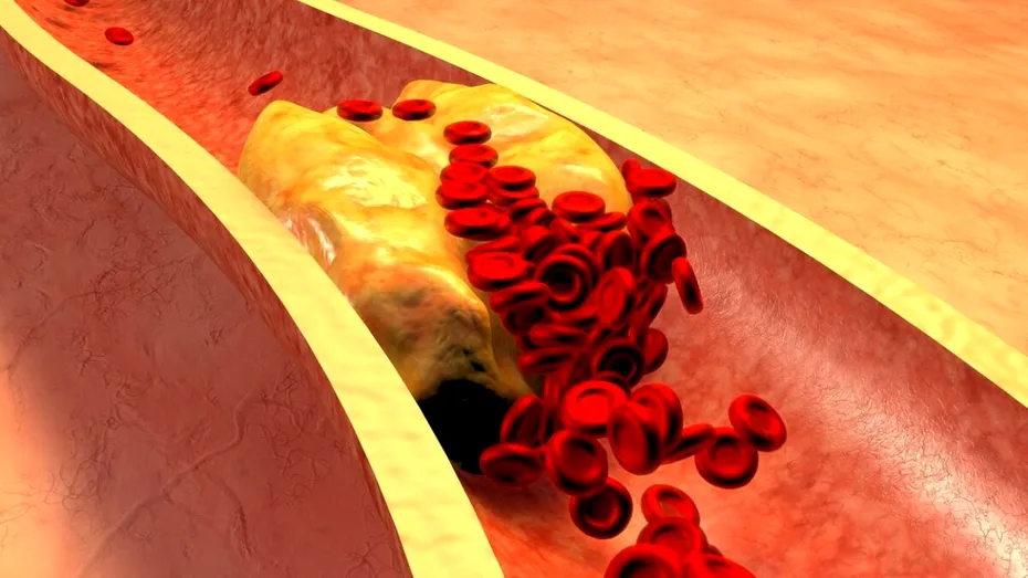 Boli grave cauzate de colesterolul crescut. 4 reguli simple pentru a aduce la normal valorile colesterolului