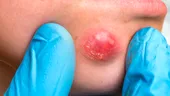 Spargerea furunculului poate determina complicaţii severe
