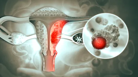 Simptomul tăcut dat de cancerul de col uterin care apare la spate + alte 8 simptome îngrijorătoare