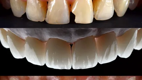 5 mituri despre faţetele dentare, demontate de medicul dentist