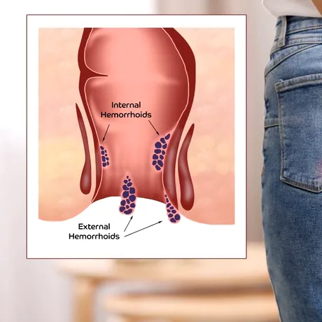 Ce să mănânci pentru a reduce riscul de cancer colorectal. Alimentele recomandate la micul dejun, prânz și cină și ce ar trebui să eviți