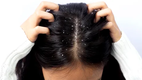 Remedii naturale pentru combaterea mătreții. Soluții simple pentru un scalp sănătos