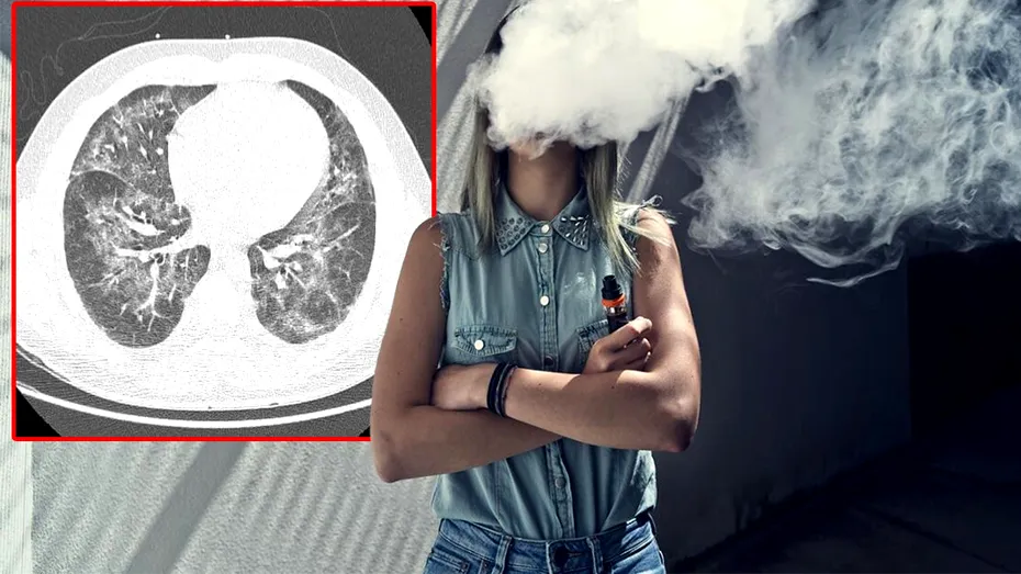 Avertismentul medicilor. Boala Evali face ravagii: 