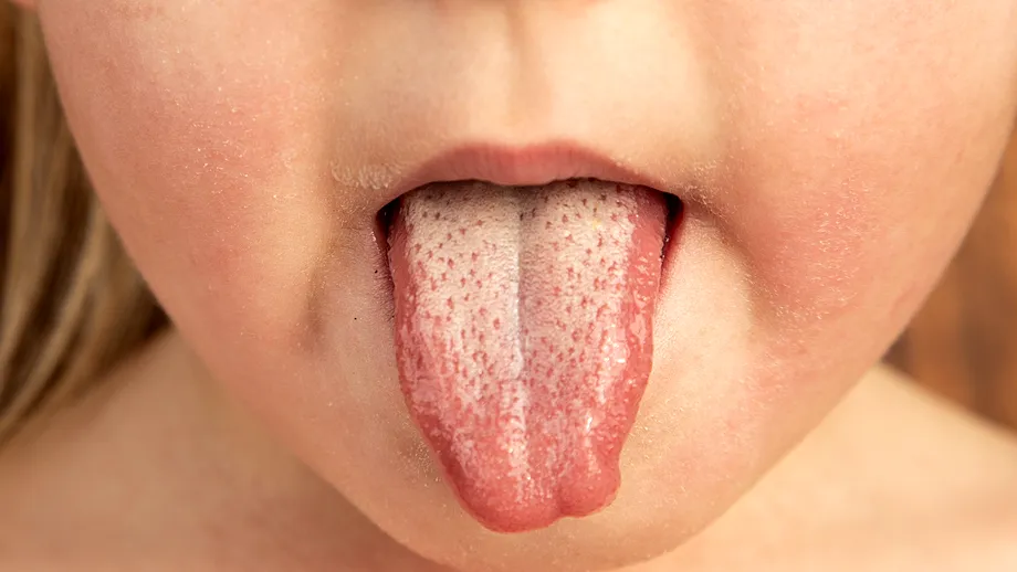 Boala infecțioasă care face ravagii la început de iarnă. Sunt afectați copiii cu vârsta între 3 și 10 ani