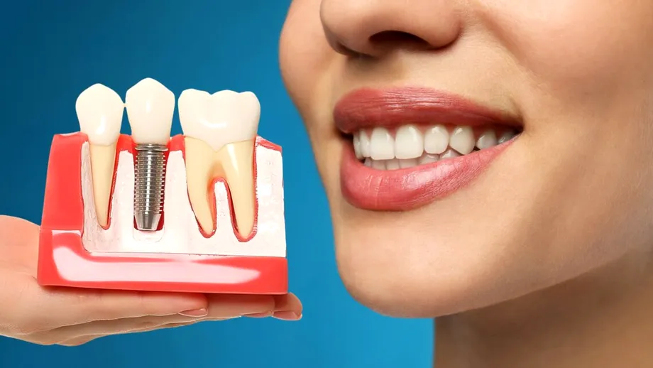 Implantul dentar, cea mai modernă și eficientă cale pentru înlocuirea dinților pierduți