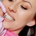(P) Cât costă fațetele dentare pentru toată gura