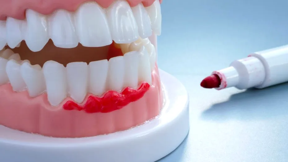 Cum scapi rapid de sângerări gingivale cu ajutorul laserului