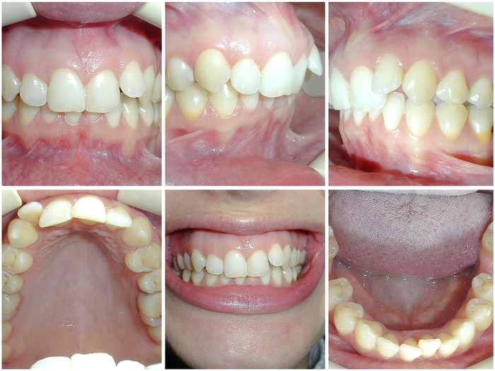 Caz inițial- zâmbetul gingival înainte de tratament