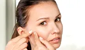 Pasta de dinţi şi soarele elimină coşurile? Descoperă 6 mituri frecvente despre acnee