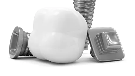 Implanturi dentare ieftine vs. implanturi scumpe. Iată 6 elemente care fac diferenţa!