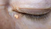 Semnul din ochi care este un indicator pentru colesterolul crescut