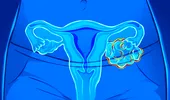 Cancerul ovarian atacă și fetele sub 18 ani! Factori de risc și primele semnale de alarmă