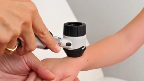 Primul semn al cancerului de piele! La ce să fii atent, ca să-ți crești șansele de vindecare