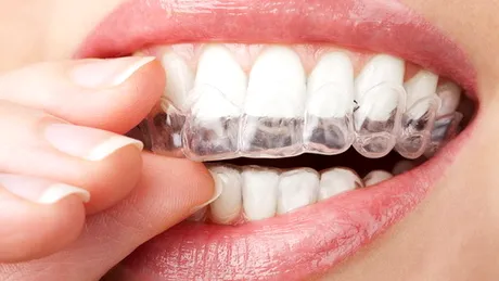 Cum ne păstram dinţii albi cât timp purtăm aparat