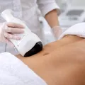 (P) Liposucția nechirurgicală Liposonix – cum funcționează și pentru cine este potrivită