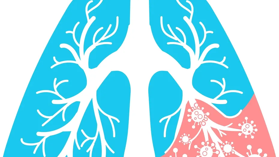 A fost depistat un nou tip de pneumonie. Primele persoane au fost deja infectate