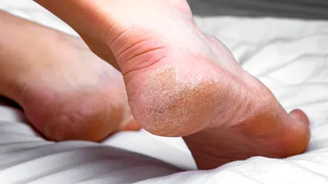 Călcâie crăpate și uscate? Trucul simplu recomandat de Dr. Adina Alberts