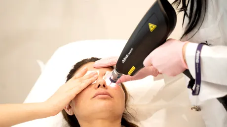 Melasma: petele pigmentare care se intensifică vara și pot fi tratate eficient toamna