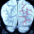 7 semne „tăcute” de alarmă care pot indica faptul că trebuie să faci angiografie cerebrală