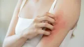 Dermatita atopică: 10 soluții care te ajută să oprești mâncărimea