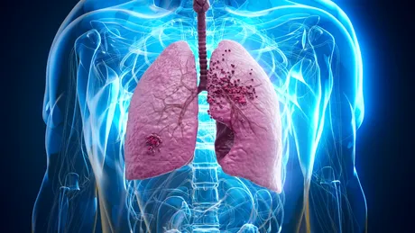 De ce cancerul poate reveni după ani de zile. Cum poate fi prevenită recidiva