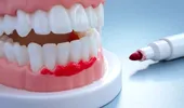 Cum scapi rapid de sângerări gingivale cu ajutorul laserului