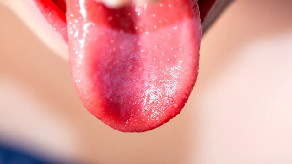 Ce este și cum se manifestă „limba geografică”! 3% dintre oamenii din întreaga lume se confruntă cu această afecțiune