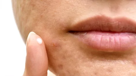 VITAMINELE care îți lipsesc dacă apar mereu coșuri pe față