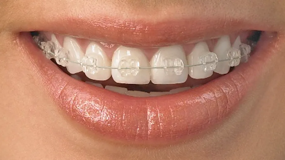 Ce nu știi despre ortodonție și aparate dentare