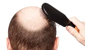 Implantul de păr la bărbaţi: cum se face şi în cât timp se văd rezultatele?