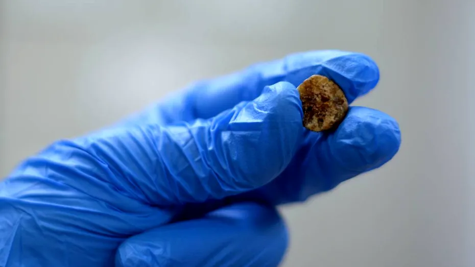 Adio, pietre la fiere! Alimentul de origine animală care poate reduce riscul de calculi biliari. Stimulează golirea vezicii biliare